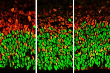 Image showing brain cells with lower levels of Foxp1 function (at left) and higher levels (right). Apical radial glia are stained in green and secondary progenitors and neurons stained in red.