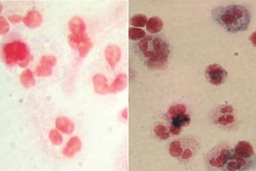 At left, image shows white blood cells (red) from one of the X-CGD clinical trial participants before gene therapy. At right, after gene therapy, white blood cells from the same patient show the presence of the chemicals (blue) needed to attack and destroy bacteria and fungus.