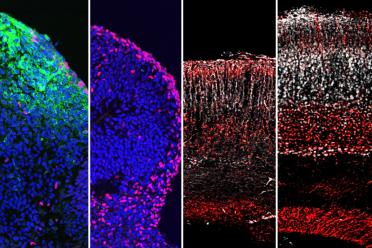 Left to right: Zika virus (green) infects and destroys the formation of neurons (pink) in human stem cell-derived brain organoids. Administration of 25HC blocks Zika infection and preserves neuron formation in the organoids. Reduced brain size and structure in a Zika-infected mouse brain. Administration of 25HC preserves mouse brain size and structure.