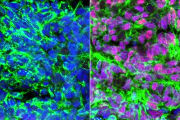 Human embryonic stem cell-derived neurons (green) showing nuclei in blue. Left: with retinoic acid added. Right: with retinoic acid and BMP4 added, creating proprioceptive sensory interneurons (pink).