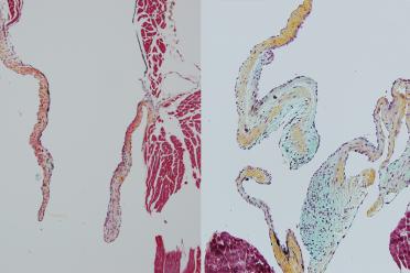 Microscopic images of a normal heart valve in a mouse, left, and a heart valve grown in a lab with heart-derived macrophages blocked, right. Without those macrophages, the valves are thick and deformed.