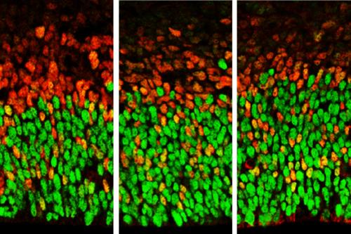 Image showing brain cells with lower levels of Foxp1 function (at left) and higher levels (right). Apical radial glia are stained in green and secondary progenitors and neurons stained in red.