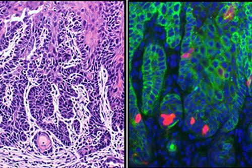 At left, head and neck squamous cell carcinoma invasive growth, and at right, cancer stem cells (shown in red) in head and neck squamous cell carcinoma.