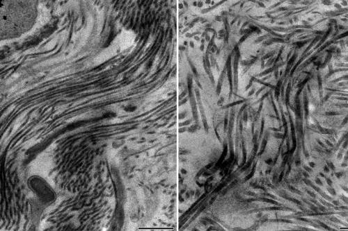 Electron microscopy images showing a healthy scar containing collagen type 5 with scar fibers smoothly arranged in parallel (left) and unhealthy scar containing no collagen type 5 with a disorganized architecture with disarray of scar fibers (right).