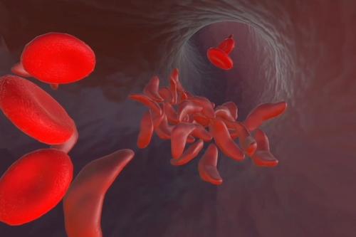 A mix of healthy red blood cells and misshapen cells caused by sickle cell disease. These sickle-shaped cells can clog arteries, producing a range of serious health effects.